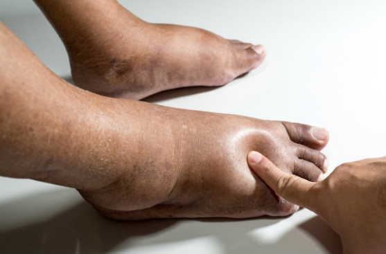 Understanding Edema: How to Identify and Manage This Common Condition